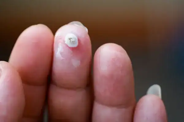 Image of white wart before cryopen treatment Wales