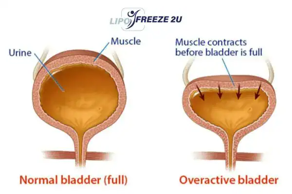 diagram of overactive bladder treatment Wales