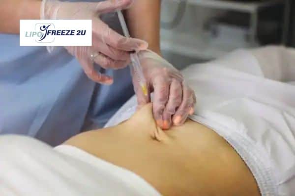 How Does Aqualyx Fat Dissolving Injection Work to Break Down Fat Wales?