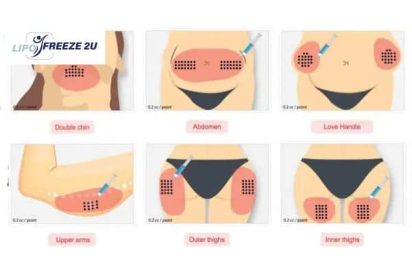 Benefits of Choosing Aqualyx for Fat Reduction Wales