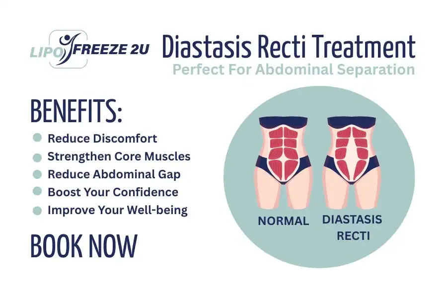 How Long Will It Take to See Improvements in Diastasis Recti Wales