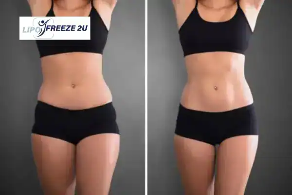 How Can LIPO FREEZE 2U Support Your Post-Pregnancy Body Recovery Wales?