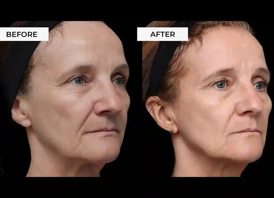 How Many RF Microneedling Sessions Will You Need to See a Difference Wales?