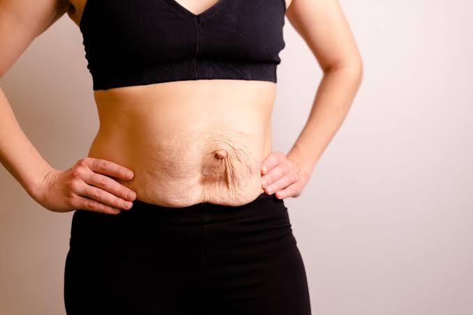 Is Surgery Really the Only Way to Repair Diastasis Recti Wales?