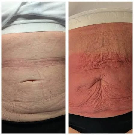 How Does RF Microneedling Improve Crepey, Thin and Uneven Skin Texture Wales?