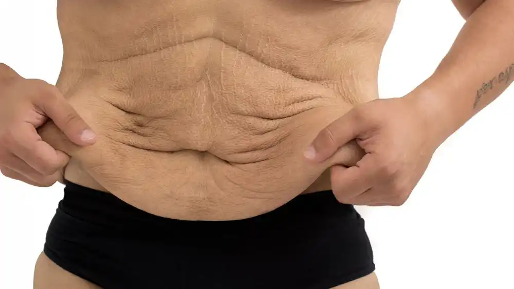 Why Does Weight Loss Medication Leave Some People With Loose or Sagging Skin Wales?